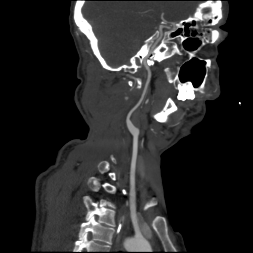 Flexion Teardrop Fracture Of C2 Image 9284