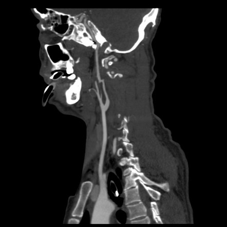 Flexion teardrop fracture of C2 | Image | Radiopaedia.org