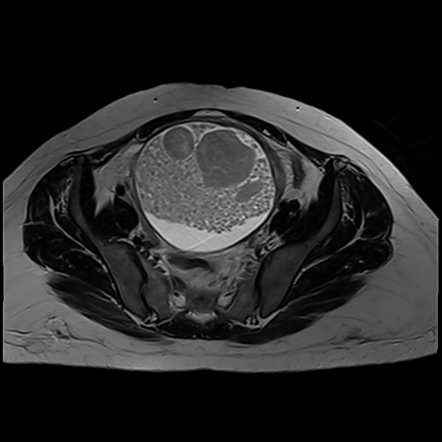 Mature cystic ovarian teratoma | Radiology Reference Article ...