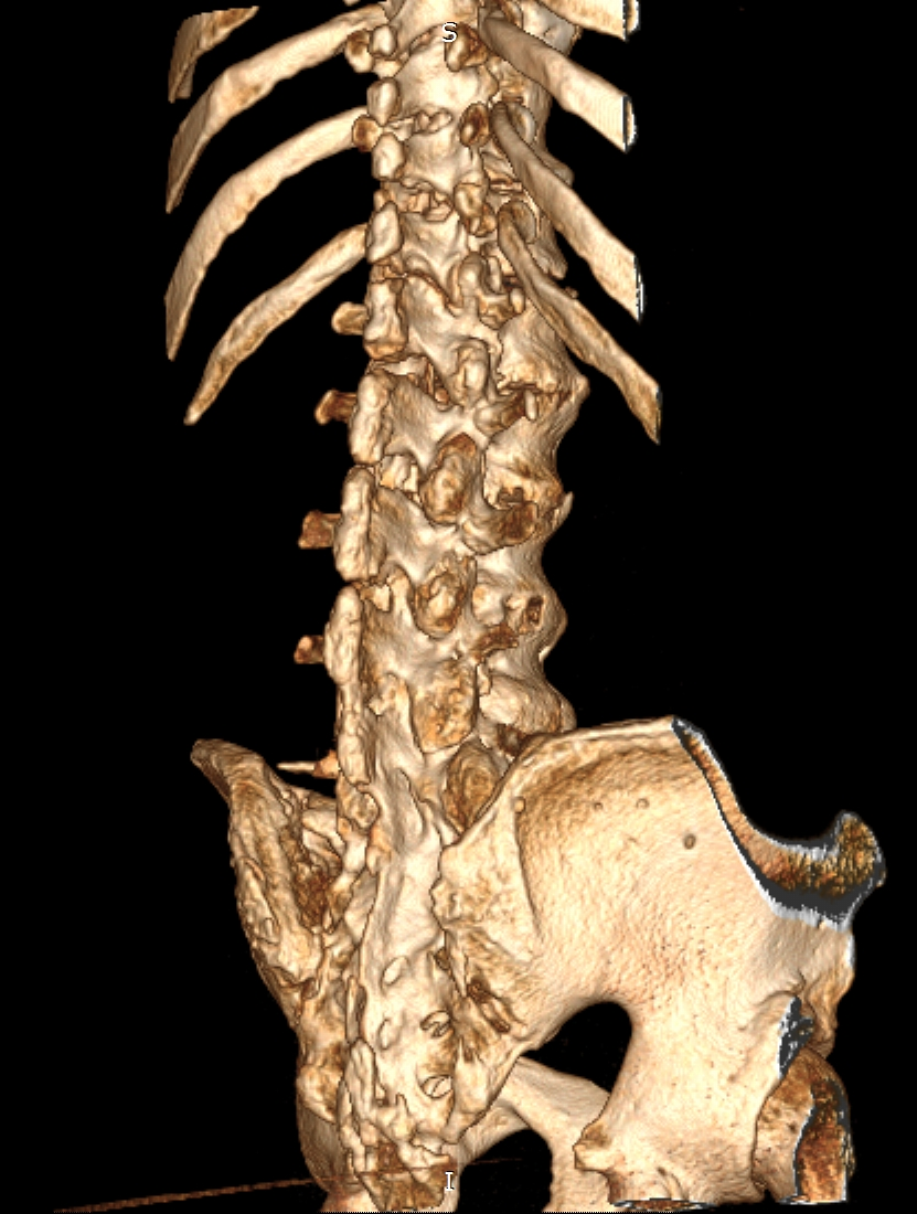 Diffuse Idiopathic Skeletal Hyperostosis Image