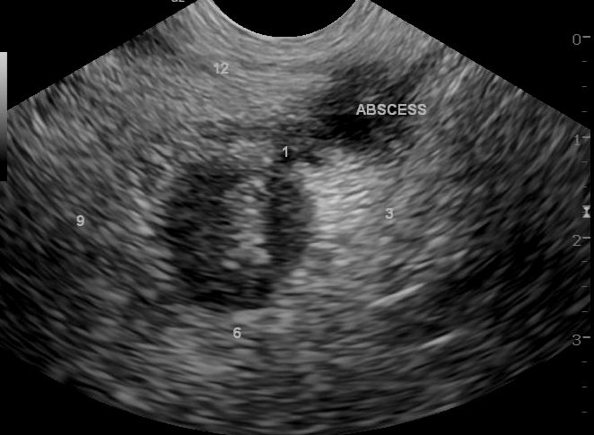 Солидное образование малого таза. Периаппендикулярный инфильтрат. Аппендикулярный абсцесс УЗИ. Аппендикулярный инфильтрат на УЗИ. Абсцедирование аппендикулярного инфильтрата на УЗИ.