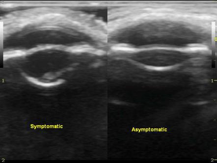 Ocular ultrasound - cataract and retinal detachment | Image ...