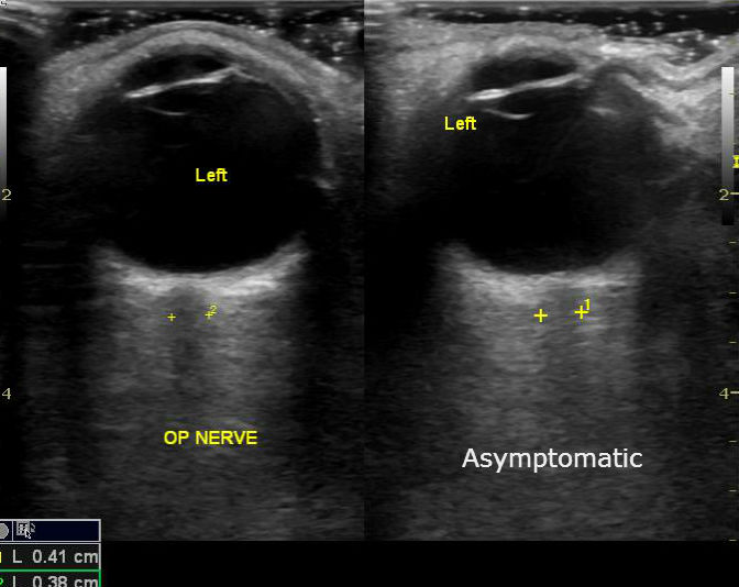 Узи глаза. УЗИ зрительного нерва в норме. Отек зрительного нерва УЗИ. УЗИ глазного яблока норма.