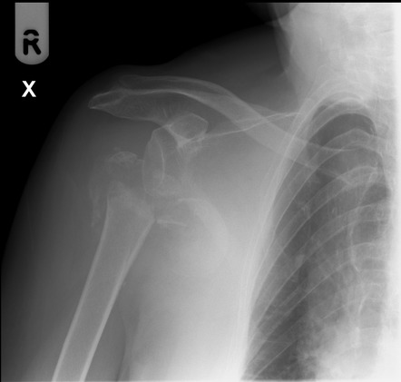 Neck of humerus fracture | Radiology Case | Radiopaedia.org