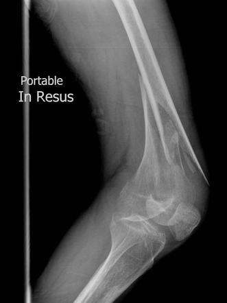 Distal femoral fracture | Radiology Reference Article | Radiopaedia.org