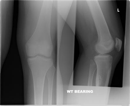 Non-ossifying fibroma | Image | Radiopaedia.org