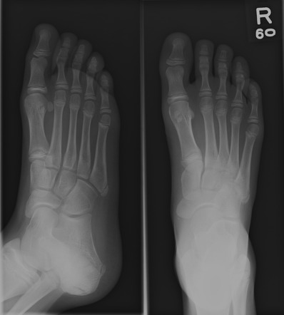 Os vesalianum pedis | Radiology Reference Article | Radiopaedia.org