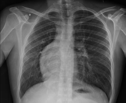 Scimitar syndrome | Radiology Case | Radiopaedia.org