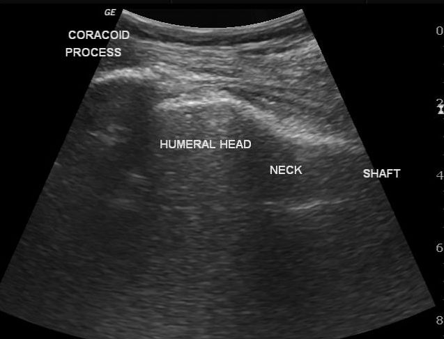 Узи плечевого. Вывих плечевого сустава УЗИ. Вывих плеча на УЗИ.