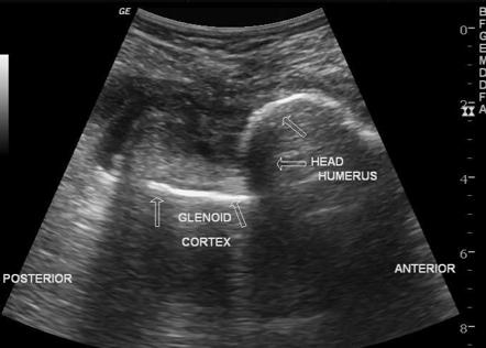 Anterior shoulder dislocation - ultrasound | Image | Radiopaedia.org