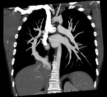 Scimitar syndrome | Image | Radiopaedia.org