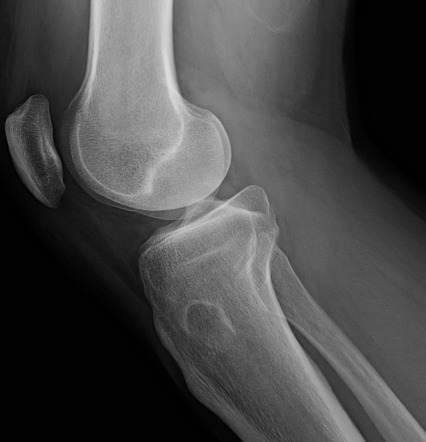 Juxtacortical chondroma | Radiology Reference Article | Radiopaedia.org