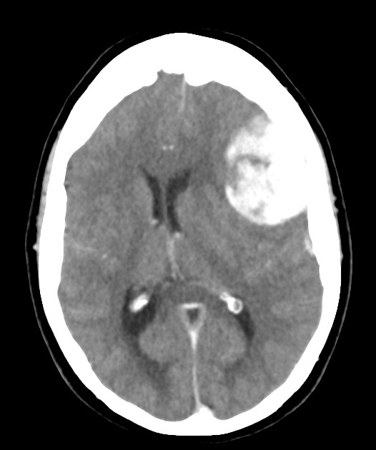 Meningioma | Radiology Reference Article | Radiopaedia.org