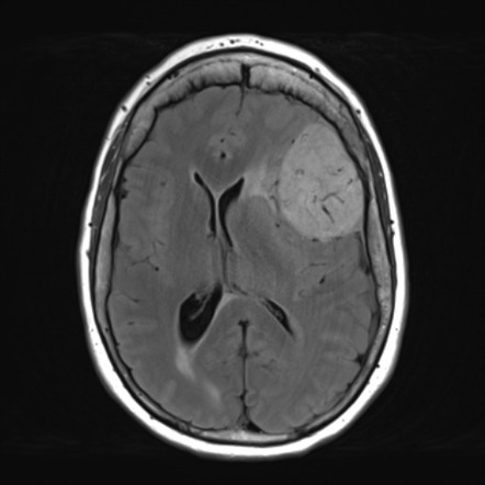 Meningioma 