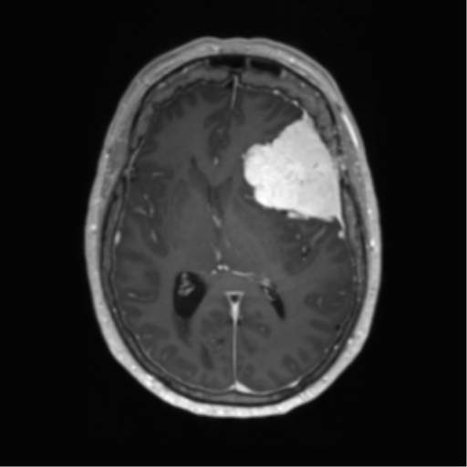 Meningioma | Image | Radiopaedia.org