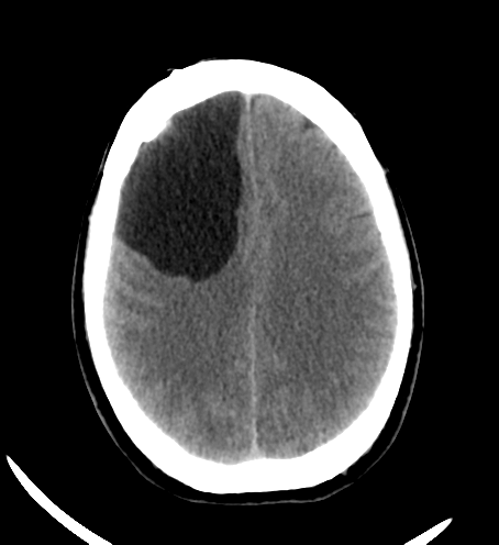 Intracranial neuroenteric cyst | Image | Radiopaedia.org