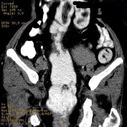 Carcinoma of sigmoid colon | Radiology Case | Radiopaedia.org