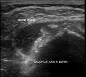 Calcific tendinitis | Radiology Reference Article | Radiopaedia.org