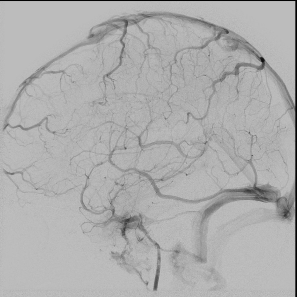 File:Proximal right MCA M1 segment embolic occlusion (Radiopaedia 56974 ...