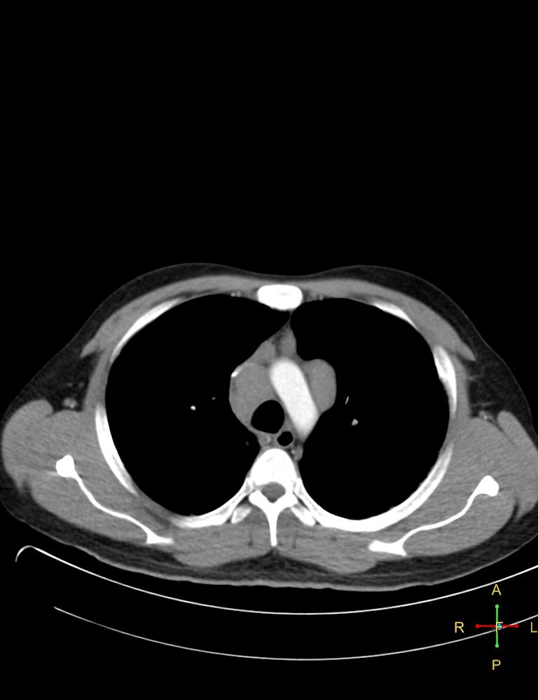 sarcoidosis-stage-ii-image-radiopaedia