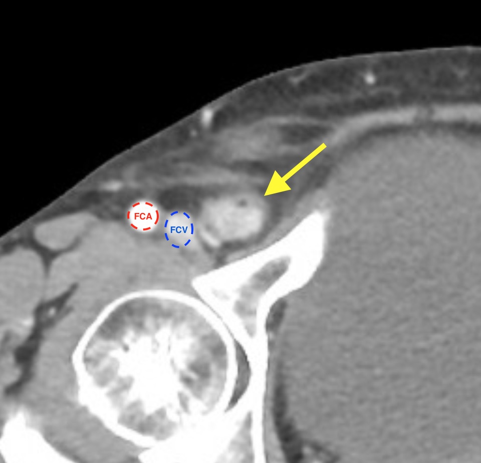 Incarcerated Femoral Hernia