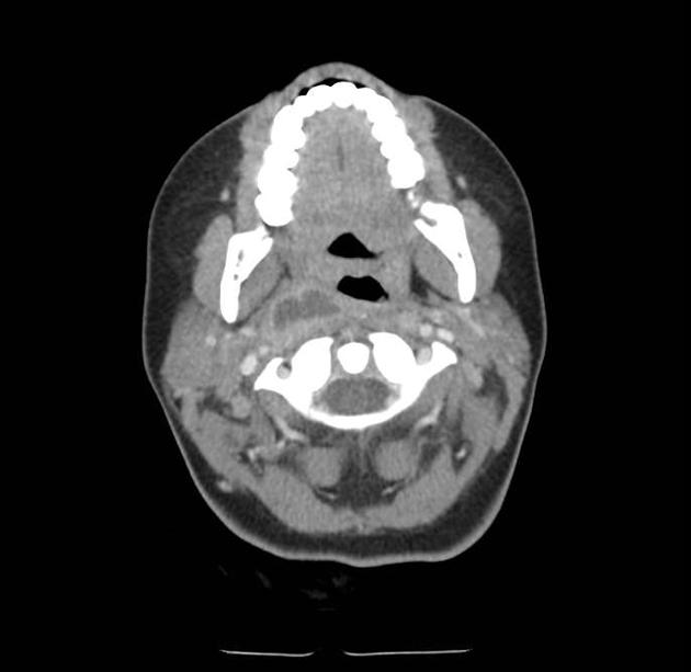 Deep Neck Space Infections