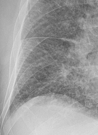 Septal Lines In Lung | Radiology Reference Article | Radiopaedia.org