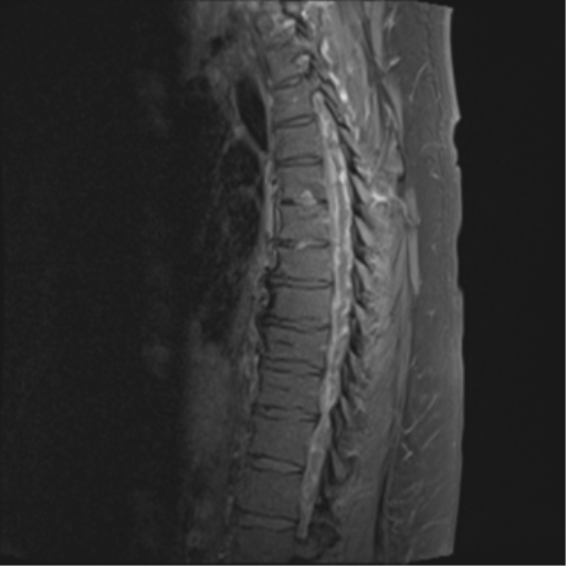 Epidural abscess | Image | Radiopaedia.org