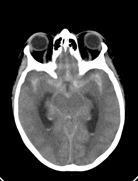 The subarachnoid hemorrhage (SAH) stages. The yellow arrows