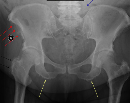 Diffuse idiopathic skeletal hyperostosis | Radiology Reference Article ...