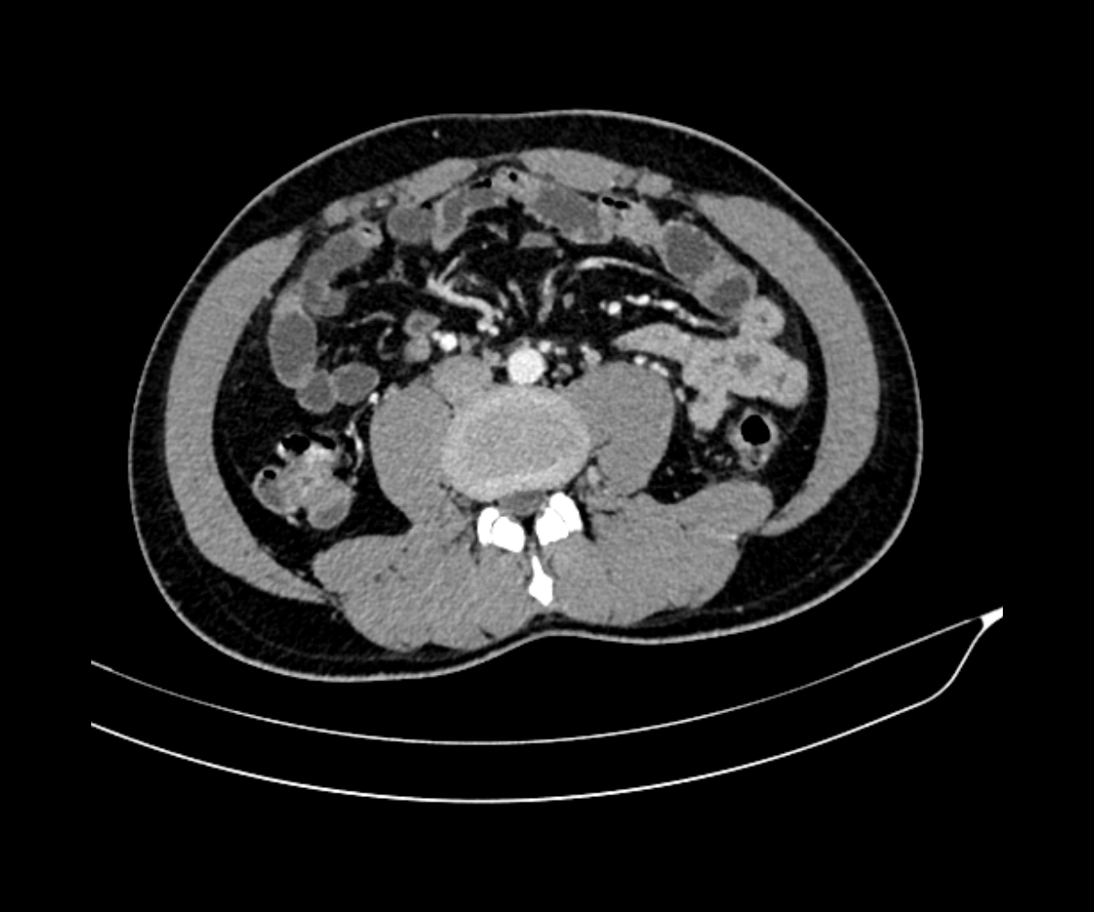 Epiploic appendigitis | Image | Radiopaedia.org