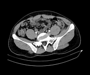 Featured image of post Epiploic Appendagitis Radiopaedia 1 epiploic appendagitis has a predominance for the cecum and sigmoid colon