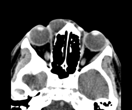 Internal angular orbital dermoid cyst - fluid density | Radiology Case ...