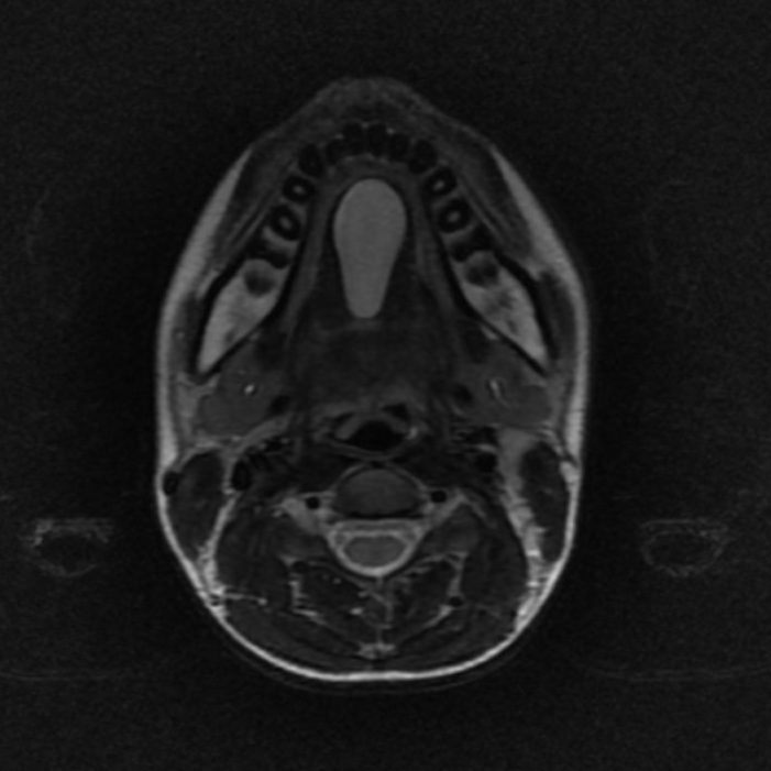 Dermoid cyst of floor of mouth | Image | Radiopaedia.org