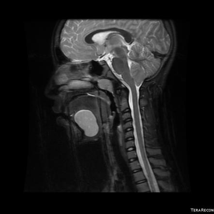 Dermoid Cyst Of Floor Of Mouth Image Radiopaedia Org