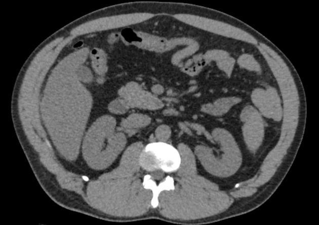 Meckel Diverticulum Radiology Case Radiopaedia Org