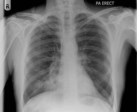 Right middle lobe consolidation | Radiology Case | Radiopaedia.org