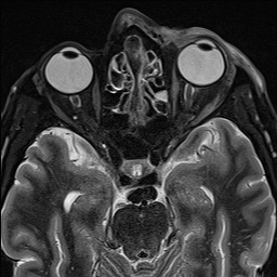 Herpes zoster ophthalmicus with orbital myositis | Image | Radiopaedia.org