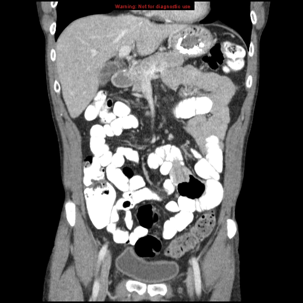 Small Bowel Intussusception Image 9900