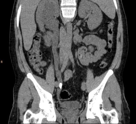 Ureteric calculus | Radiology Case | Radiopaedia.org