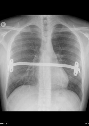 Nuss procedure | Radiology Reference Article | Radiopaedia.org