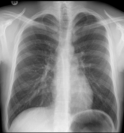 Pectus excavatum | Radiology Case | Radiopaedia.org