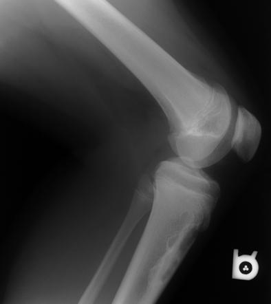 Non-ossifying fibroma | Radiology Reference Article | Radiopaedia.org