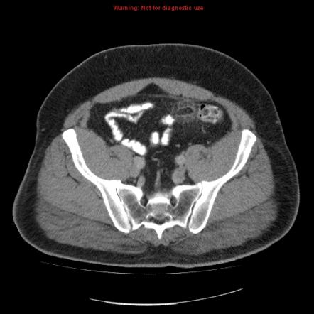 Featured image of post Epiploic Appendagitis Radiopaedia This is more commonly a condition found in young