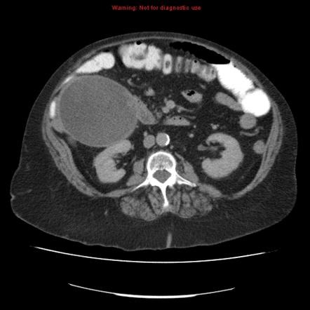 Gallbladder empyema | Image | Radiopaedia.org