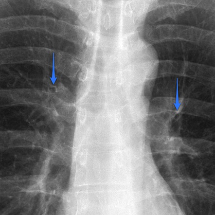 Anterior bronchus sign | Radiology Reference Article | Radiopaedia.org