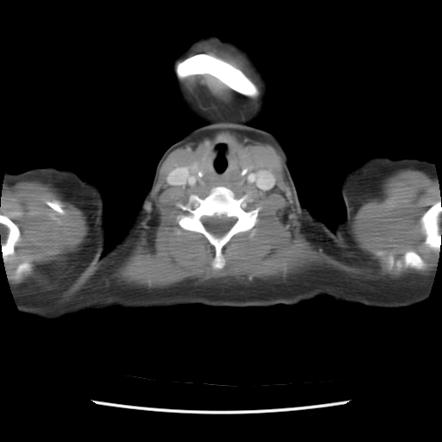 Neurogenic tumors | Radiology Reference Article | Radiopaedia.org