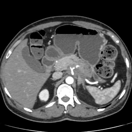 Pancreatic Ductal Adenocarcinoma | Radiology Reference Article ...