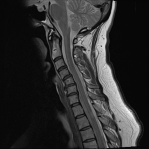 Multiple sclerosis | Image | Radiopaedia.org