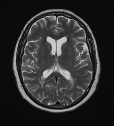 Multiple sclerosis | Image | Radiopaedia.org